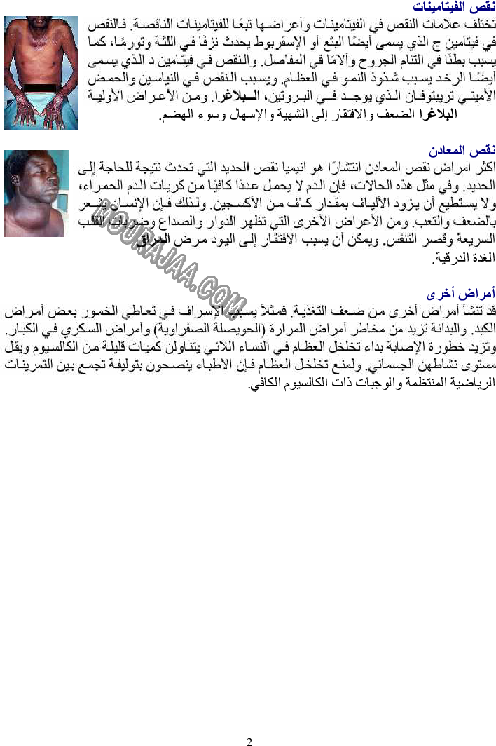 بعض الأمراض الناتجة عن سوء التغذية